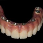 How Much is a Full Set of Dental Implants Uk