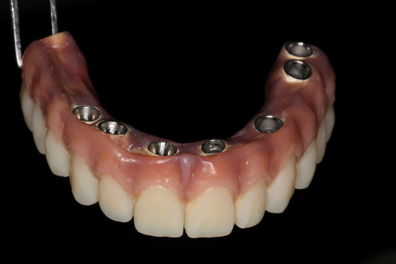 How Much is a Full Set of Dental Implants Uk